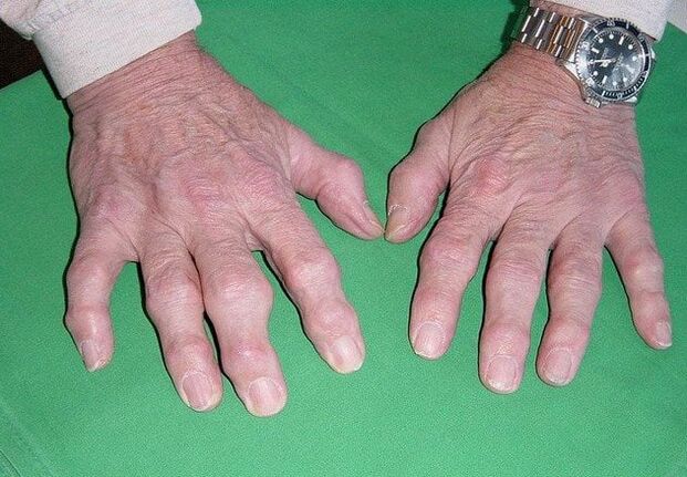 Artroza prstov
