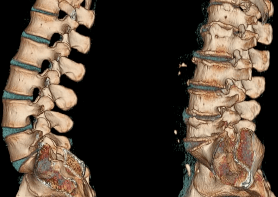 Osteohondroza