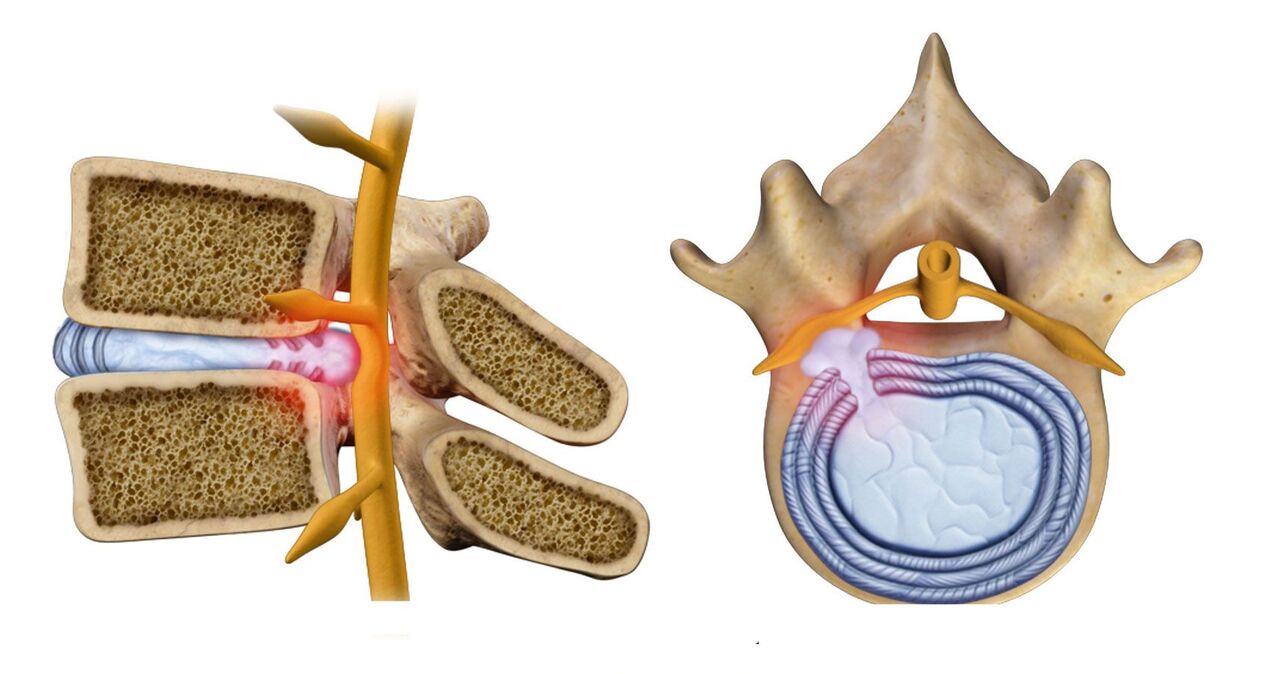 hrbtenična kila pri torakalni osteohondrozi