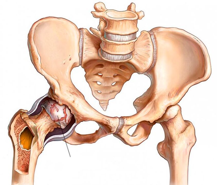 Artroza kolčnega sklepa