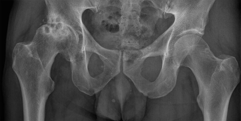 Deformacijska artroza kolčnega sklepa na rentgenskem slikanju
