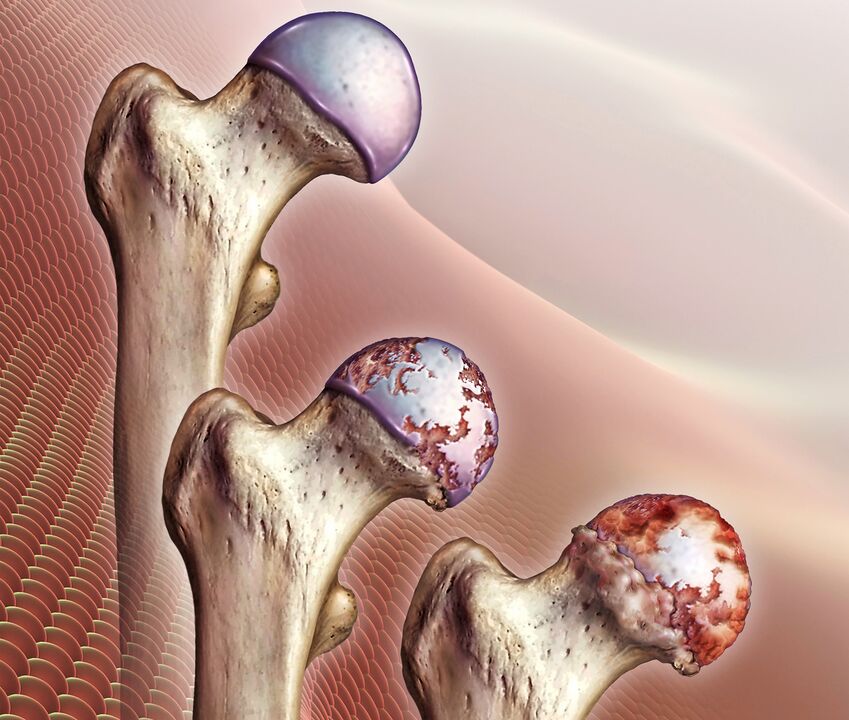 Razvoj artroze kolčnega sklepa