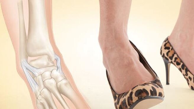nošenje čevljev s peto kot vzrok za artrozo gležnja