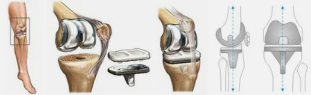 Endoprosthesis za kolena primer